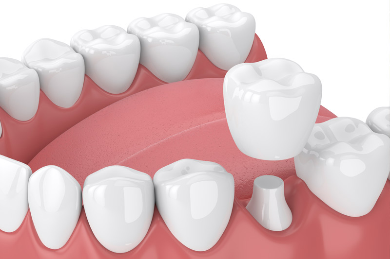 Dental Crowns in East Hampton